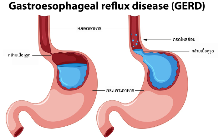 กรดไหลย้อน GERD